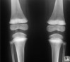 Frontal radiograph of both knees of a child with lead poisoning