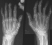 Rheumatoid arthritis xray