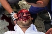 Nabi Saleh Mustafa Tamimi after being shot in the face with a high velocity tear gas canister