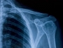 Shoulder xray