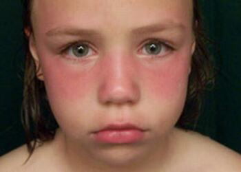 image: girl sunburned