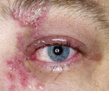 shingles on eye